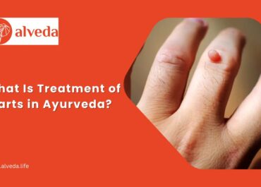 What is Treatment of Warts in Ayurveda?