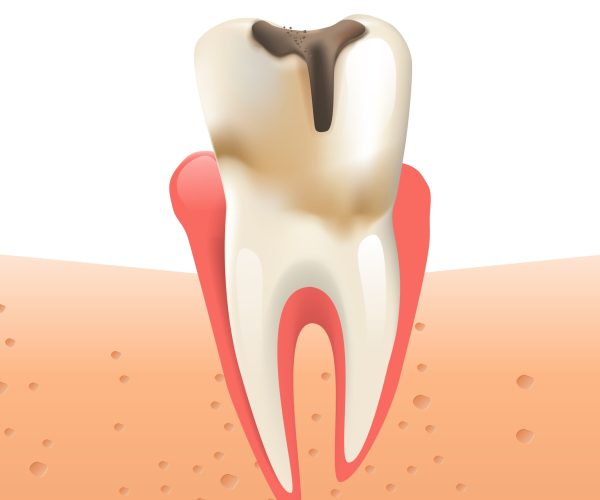Realistic Illustration Enamel Caries in 3d Vector