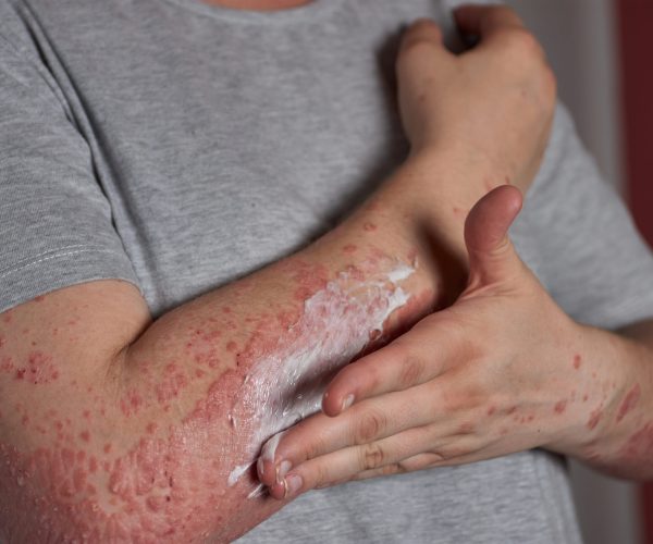Woman applying moisturizer to skin with psoriasis with her hand on her forearm