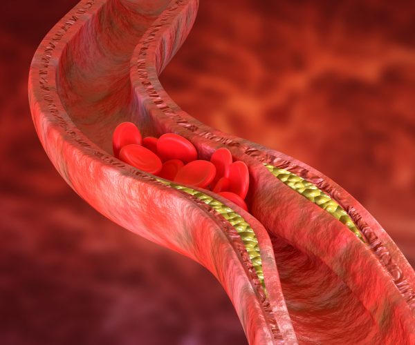 Atherosclerosis is an accumulation of cholesterol plaques in the walls of the arteries, which causes obstruction of blood flow. 3D rendering