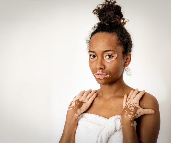 Beautiful young african american woman with vitiligo posing with towel, skin care and genetic pigmentation concepts, smiling people and body positive concept, white background