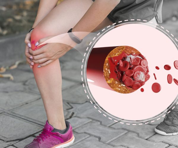 blood-clots-legs-disease (2)
