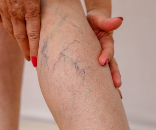 Elderly woman in white panties shows cellulite and varicose veins on a light isolated background. Concept for medicine and cosmetology.