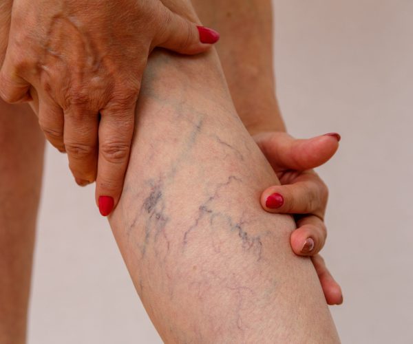 Elderly woman in white panties shows cellulite and varicose veins on a light isolated background. Concept for medicine and cosmetology.