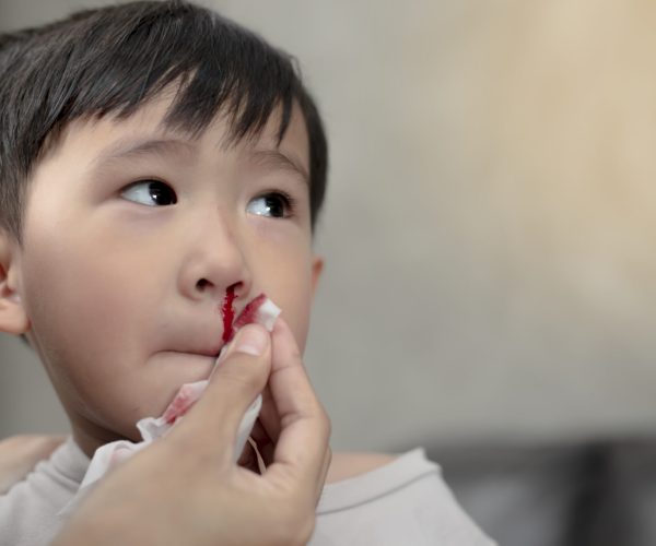Portrait of cute Asian ethnic child having nosebleed,The concept of first aid for nosebleeds.