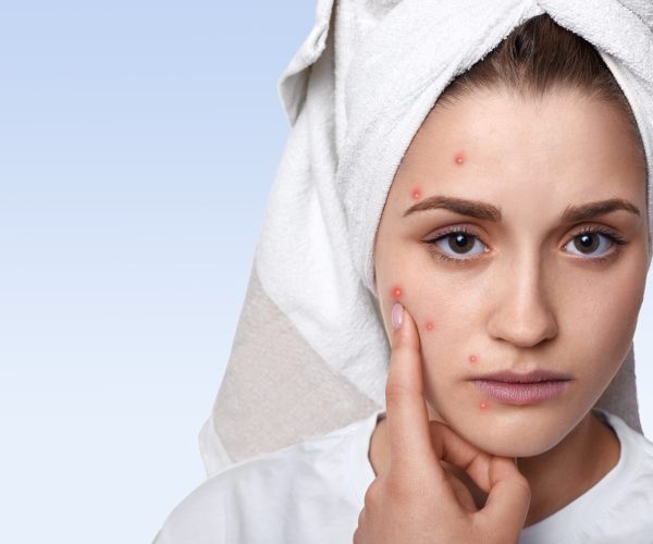 An isolated portrait of young woman having problem skin and pimple on her cheek, wearing towel on her head having sad expression pointing at her pimple being in bathroom. Beauty and spa concept.