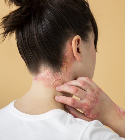 psoriasis-eczema-neck-patient