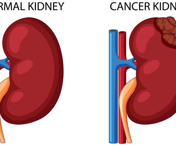 Normal kidney and cancer kidney illustration