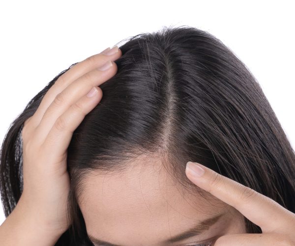young-asian-women-worry-about-problem-hair-loss-head-bald-dandruff