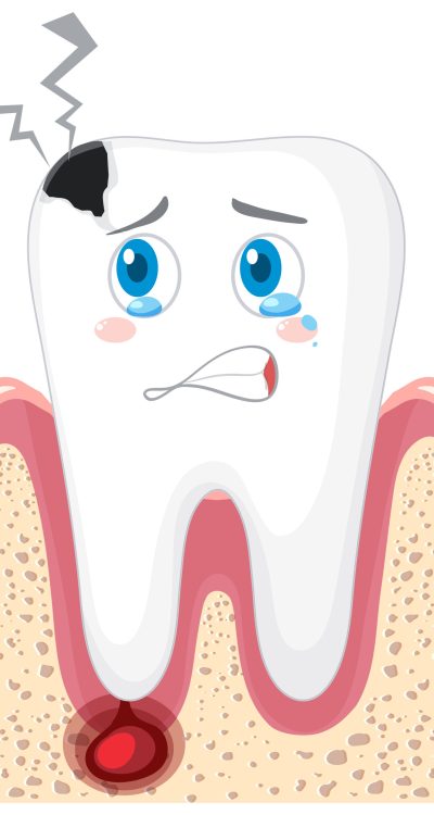 Caries and inflammation in the gums on a white background illustration